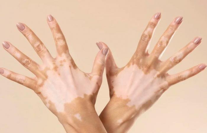 Journée mondiale du vitiligo : quatre clés de cette pathologie qui affecte la pigmentation de la peau